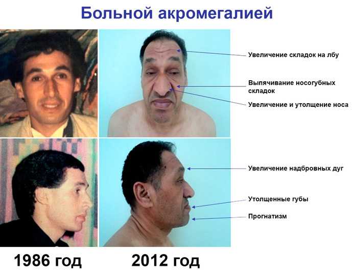 Аденома