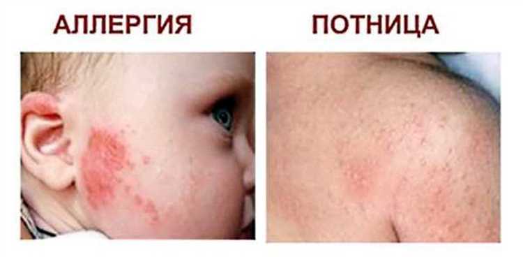 Лечение
